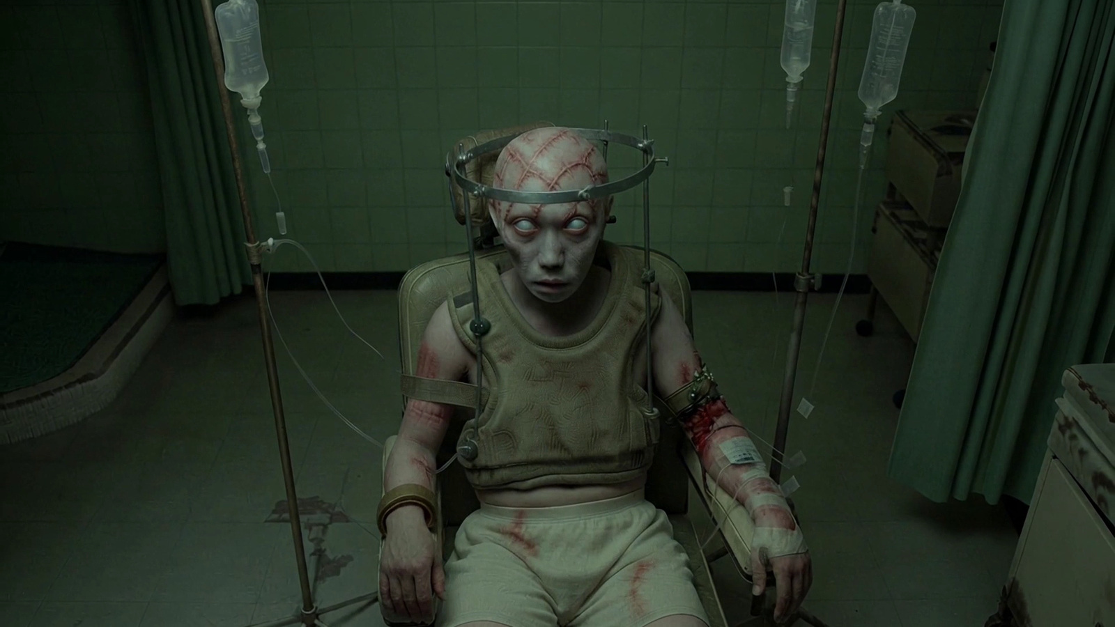 A restrained patient in a treatment chair with a halo brace and IV tubing